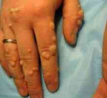 На пръстите на ръцете често се появяват брадавици