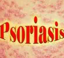 Накрая, лекарство ефективен срещу псориазис