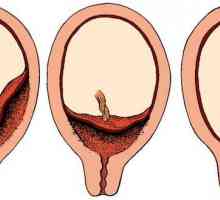 Нарушение утробата плацентарната притока на кръв и други проблеми с плацентата