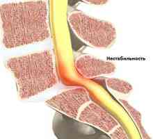 Нестабилността на цервикални симптомите на гръбначния стълб и лечението