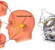 Невралгия на лицевия нерв: симптоми, лечение