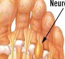 Мортън неврома (болки в стъпалото) - причини, симптоми и лечение
