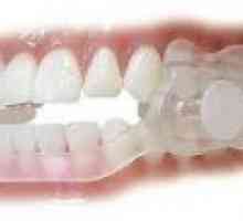 Нощно скърцане със зъби - причинява, лечение