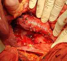 Тумор на надбъбречните жлези симптомите и лечението