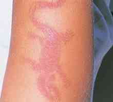 Информацията алергични прояви на дерматит