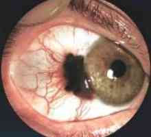 Диагностика и лечение на очите меланом