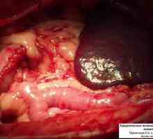 Характеристики на следоперативния период след отстраняване на дебелото черво и тумори