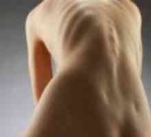 Остеопороза при жени: симптоми и лечение