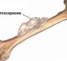 Остеосарком (остеогенна саркома) - причини, симптоми, диагностика и лечение