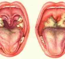 Стрептокок в гърлото - симптоми и лечение на остър фарингит