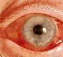 Глаукома с отворен ъгъл: симптоми и лечение