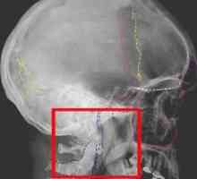 Счупване на основата на черепа