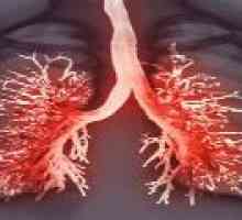 Плеврит белите дробове - симптомите и лечение на плеврит