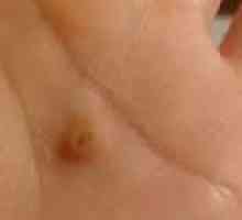 Плоски брадавици по ръцете и лицето: лечение и отстраняване