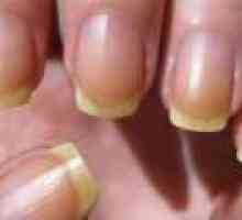 Защо жълти нокти?
