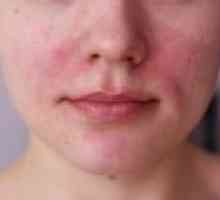 Зачервяване и възпаление на кожата, лечението