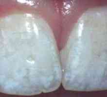 Причините за бели петна по зъбите