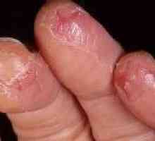 Причини и лечение на пукнатини по ръцете и пръстите