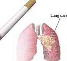 Причините за рак на белите дробове при пушачите