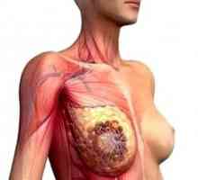 Признаци на рак при жените гръдната кост