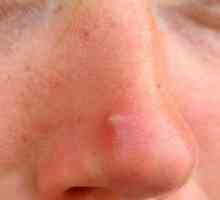 Пъпки по носа: на причините, за лечение и профилактика