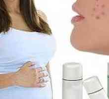 Акне по време на бременност, причини, лечение