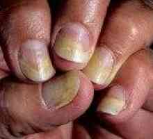 Псориазисът на ноктите на лечение на ръцете и краката