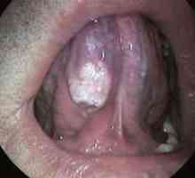 Рак на езика