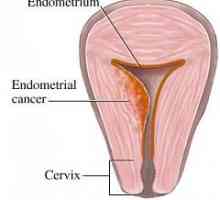 Рак на ендометриума