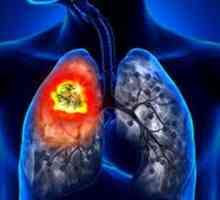 Рак на белия дроб: Симптоми и признаци