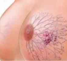 Рак на гърдата: Причини, симптоми, лечение