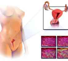 Ракът на маточната шийка: Признаци и симптоми