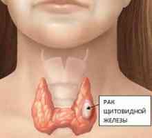Рак на щитовидната жлеза