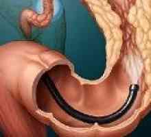Сигмоидна рак на дебелото черво: причини, симптоми, лечение
