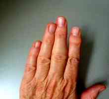 Ревматоиден артрит на пръстите, първите симптоми
