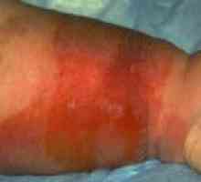 Еризипел долната част на крака: диагностика и лечение