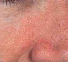 Себореен дерматит (екзема маслен) лицето: причинява, лечение и профилактика
