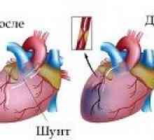 Сърце байпас хирургия съдове (байпас на коронарната артерия)