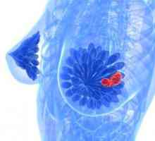 Симптомите и лечението на кисти на гърдата