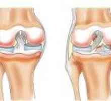Симптоми и лечение на разкъсване на менискуса на коляното