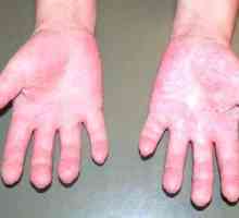 Симптоми и лечение на алергия към студа