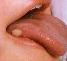 Симптомите на рак на езика
