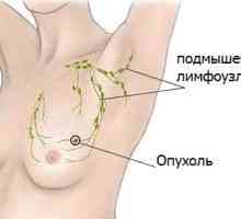 Симптомите на рак на гърдата