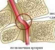 Синдромът на гръбначния артерия в цервикалния остеохондроза