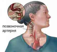 Синдромът на гръбначния артерия в цервикалния остеохондроза: симптоми, превенция