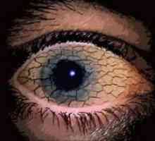 Синдром на сухото око