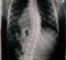 Сколиоза на гръбначния стълб при възрастни: диагностика, профилактика, лечение