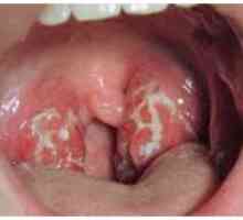 Стрептококи инфекция на гърлото
