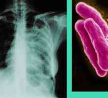 Туберкулоза - Симптоми и признаци на