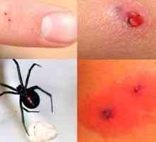 Ухапвания от паяк - симптоми, лечение